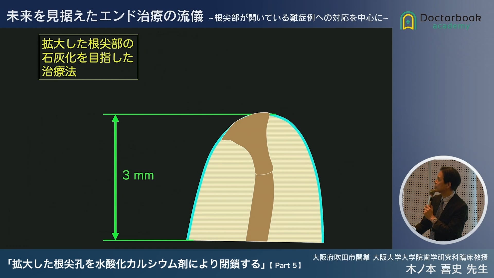 臨床知見録_根管充塡_根尖部を石灰化させる術式