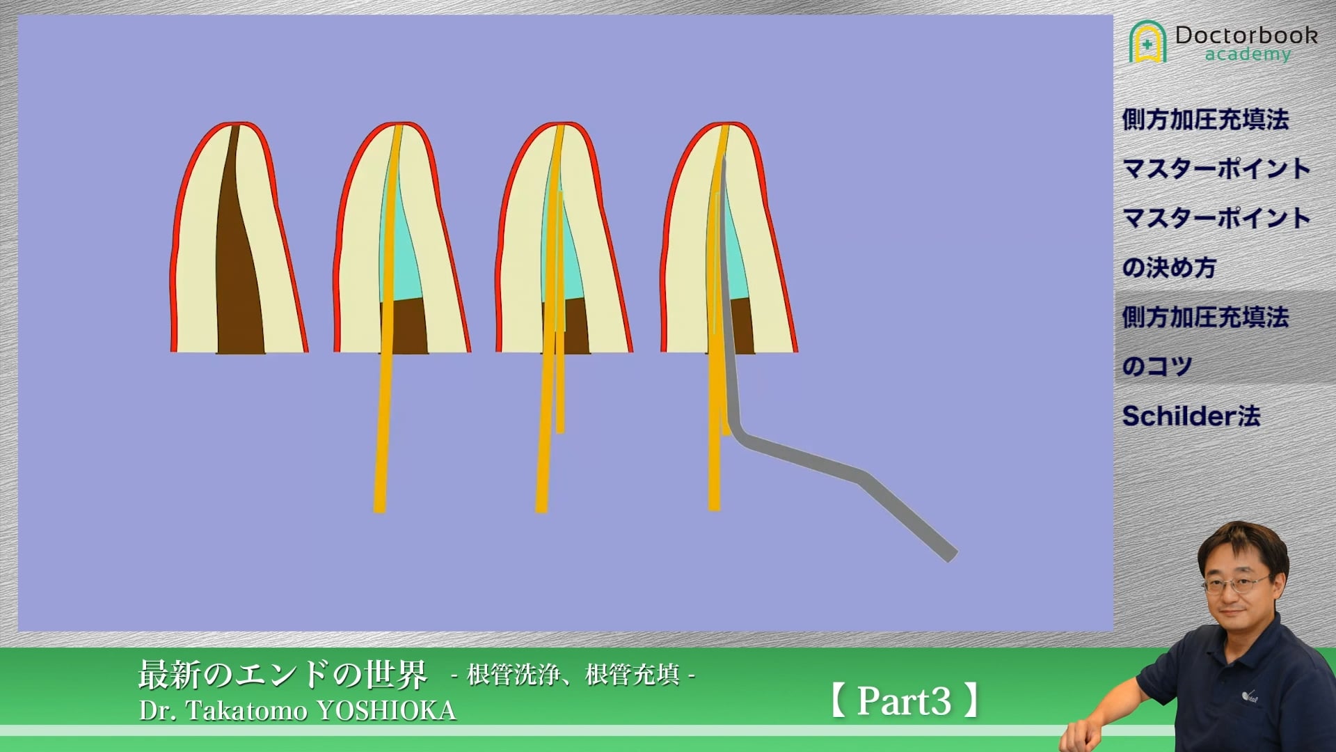 臨床知見録_根管充塡_側方加圧充填法のコツ