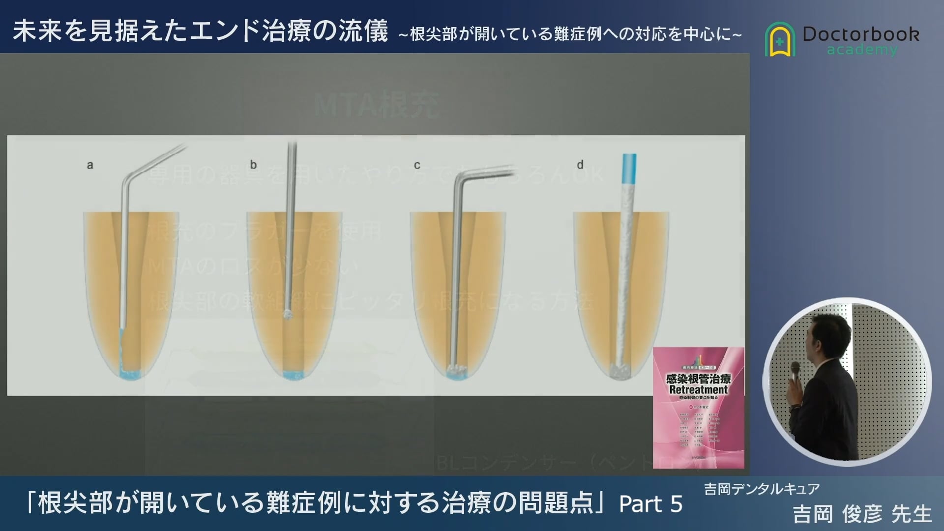 臨床知見録_根管充塡_MTA根充の方法