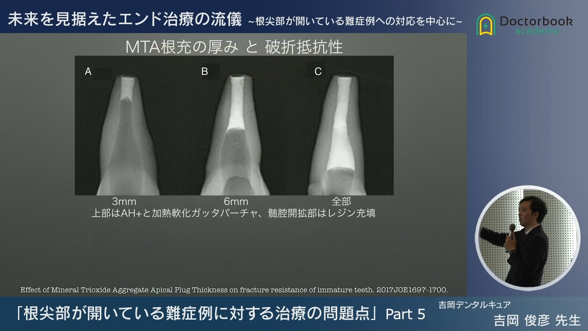 臨床知見録_根管充塡_破折強度の変化