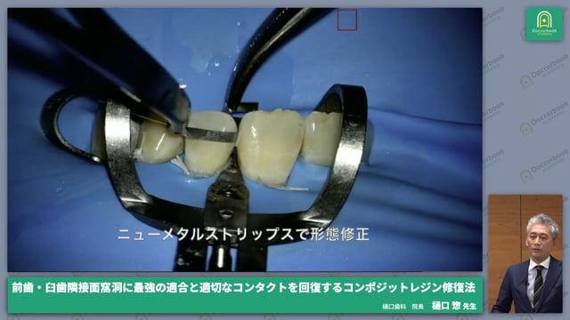 前歯・臼歯隣接面窩洞に最強の適合と適切なコンタクトを獲得するコンポジットレジン修復法