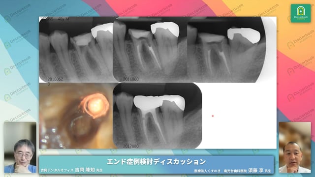 パーフォレーションがある第一大臼歯にMTAを用いた症例と長期予後