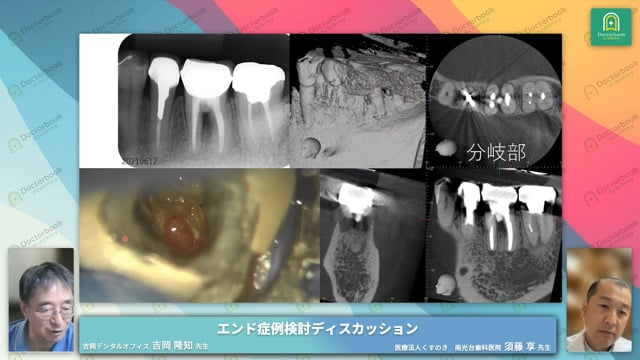 MTAで根管充填後14年間で3回再発した症例│パーフォレーションリペアとBGマルチ