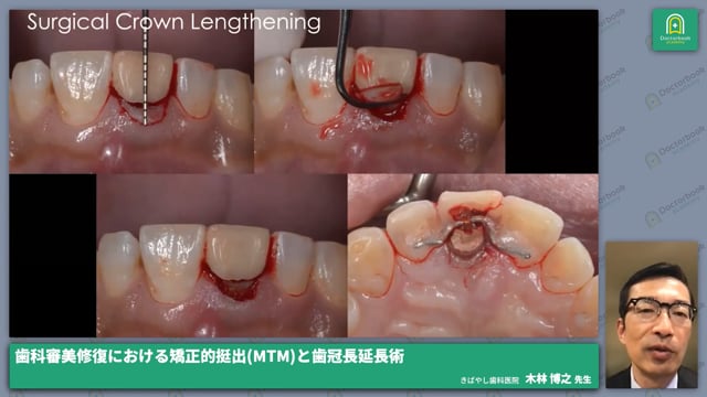 矯正的挺出（MTM）＋外科的歯冠長延長術（SCL）の併用 #3
