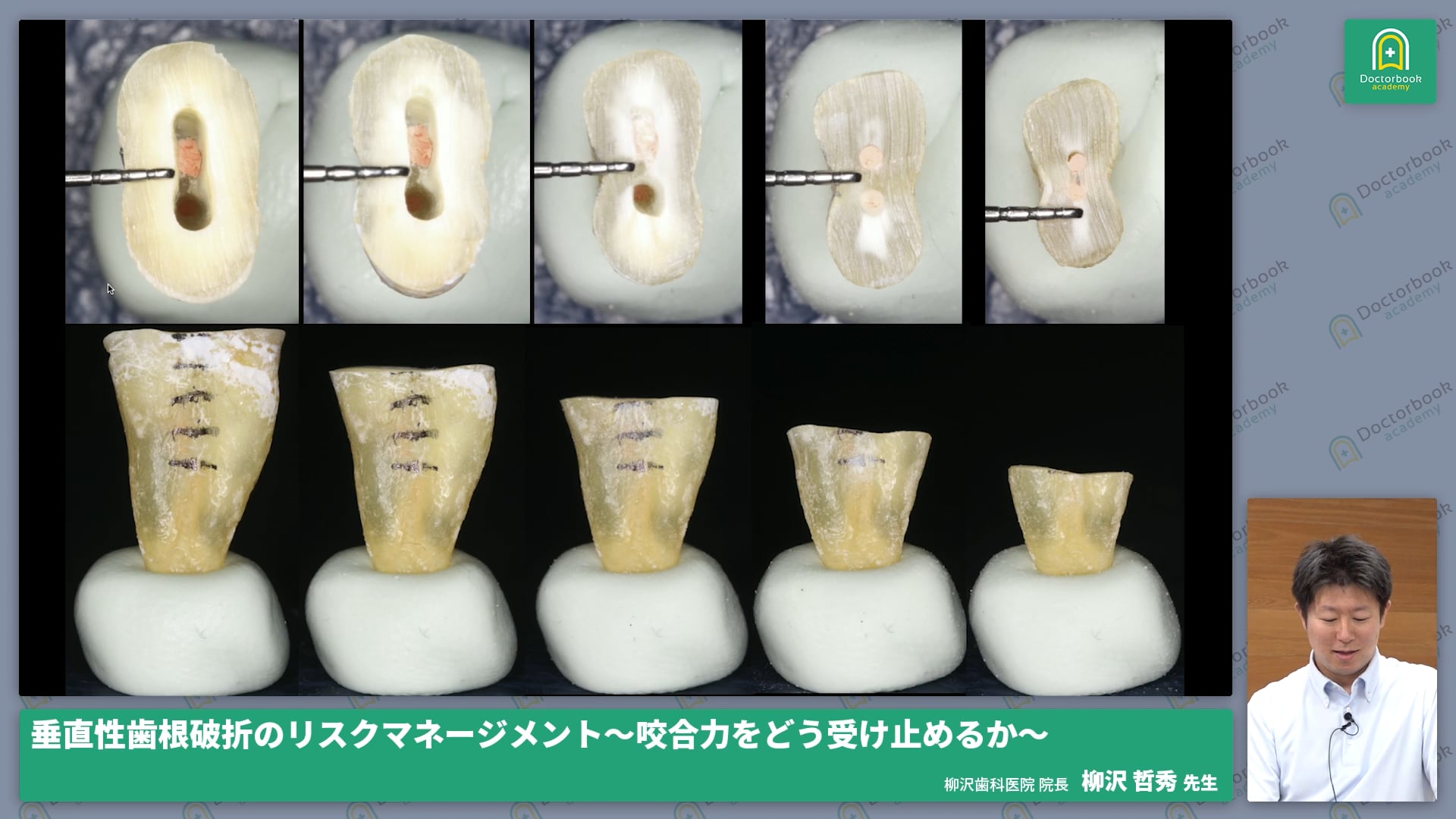 垂直性歯根破折のリスク軽減の勘所 〜咬合力をどう受け止めるか〜