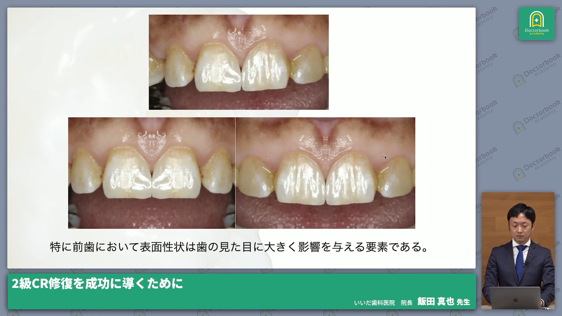 CR修復における色と形態の捉え方 #3