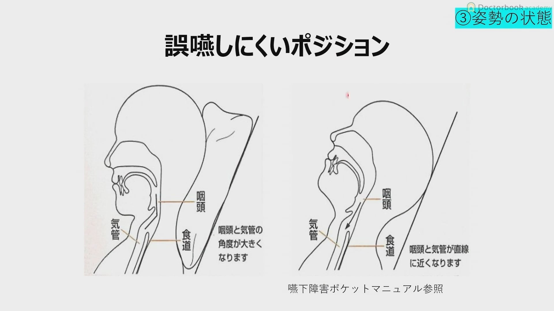 臨床知見録_訪問診療_誤嚥しにくいポジション