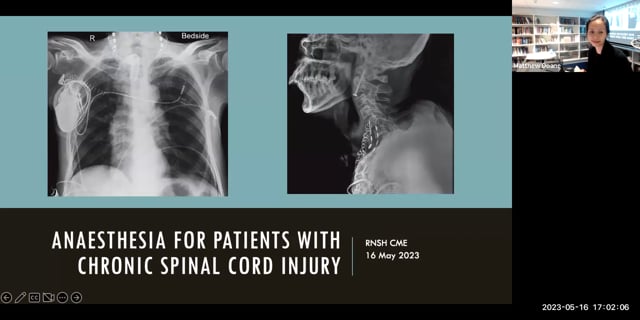 Anaesthesia for Patients with Chronic Spinal Cord Injury