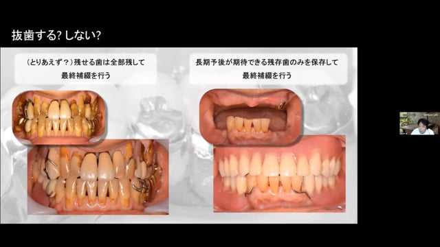 義歯治療を行う上で歯周治療を理解すべき理由│和田淳一郎先生