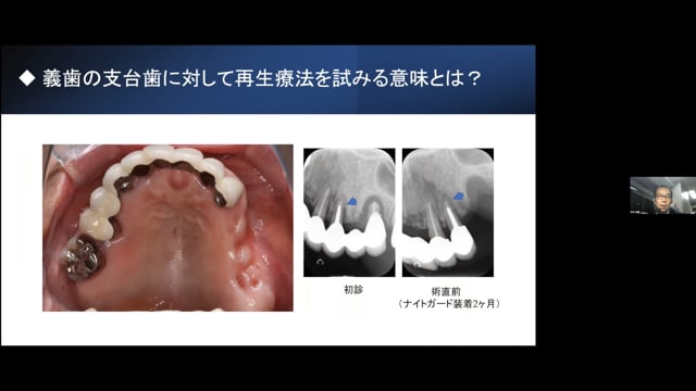 義歯臨床家が知っておくべき歯周治療の基本│水谷幸嗣先生