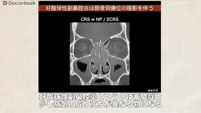 好酸球性副鼻腔炎の疾患概要