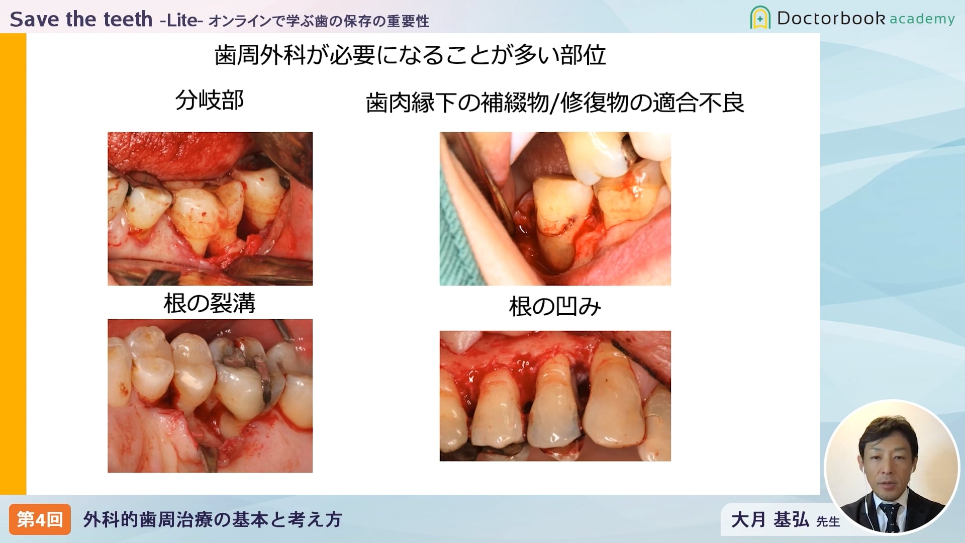 臨床知見録_歯周外科治療_外科的歯周治療の前に非外科的歯周治療は必要か？