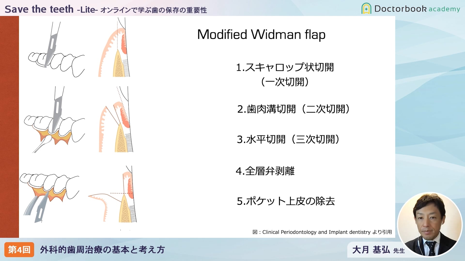 臨床知見録_歯周外科治療_Modified Widman flap