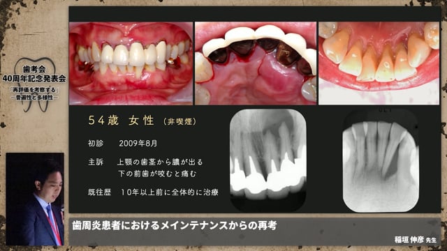 【ペリオ班】歯周炎患者におけるメインテナンスからの再考察│稲垣 伸彦 先生