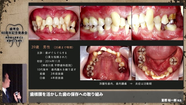 【ペリオ班】歯根膜を活かした歯の保存への取り組み│富樫 裕一郎先生