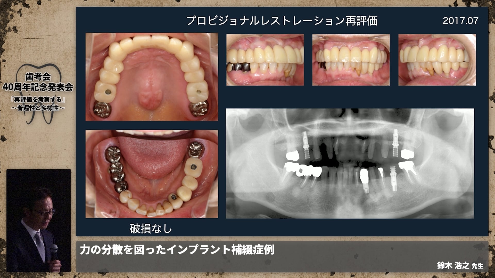 【補綴班】力の分散を図ったインプラント補綴症例│鈴木 浩之先生