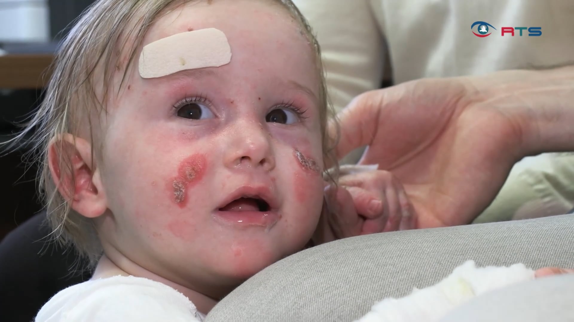 schmetterlingskinder-wie-eine-salzburger-forschungseinrichtung-die-epidermolysis-bullosa-heilen-will