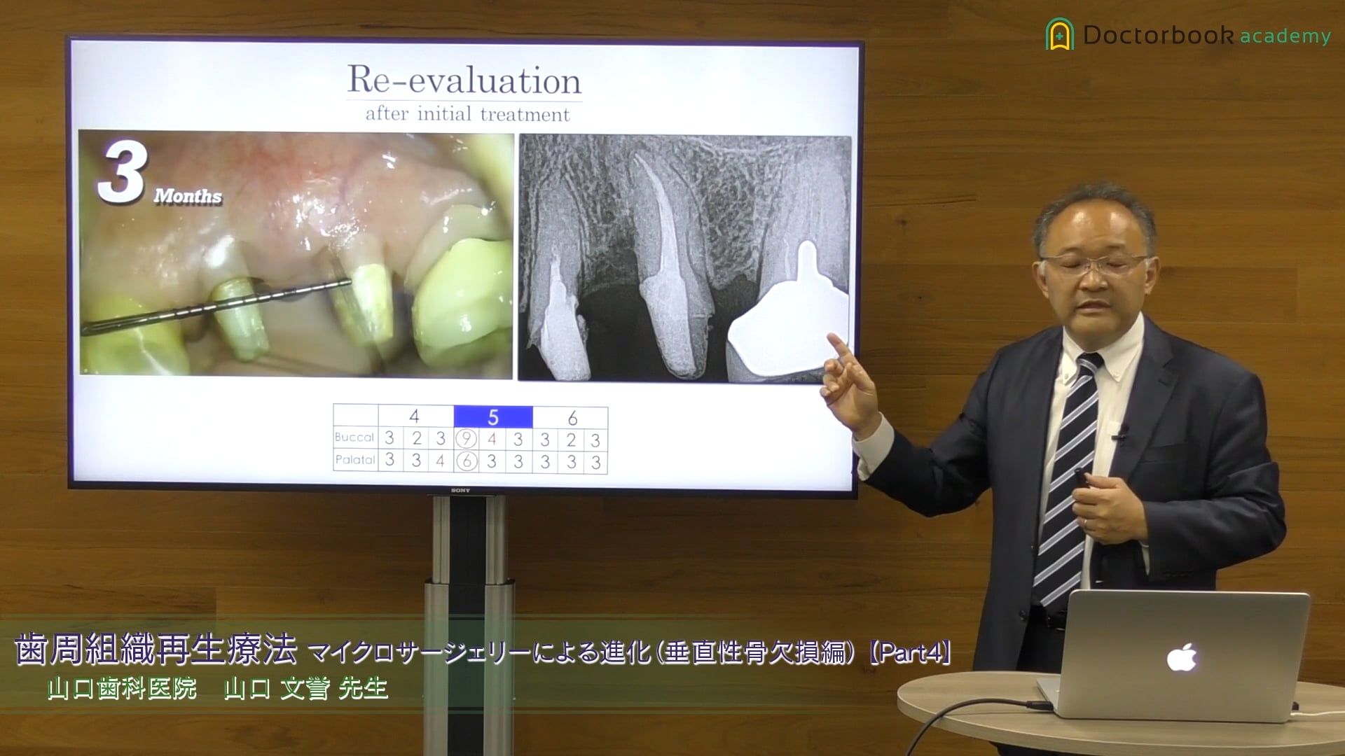 臨床知見録_歯周組織再生療法_Intrabony defectに関するデシジョンメイキングについて