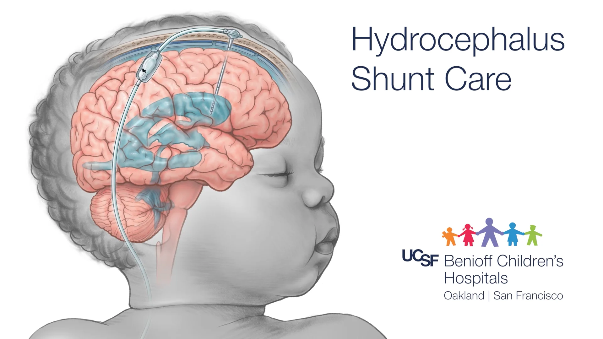 Hydrocephalus and Shunts, Fact Sheet, Health Information