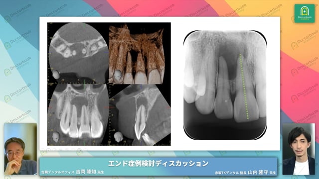 右上1番、2番 根尖病巣へのアプローチ│山内 隆守先生 CASE1