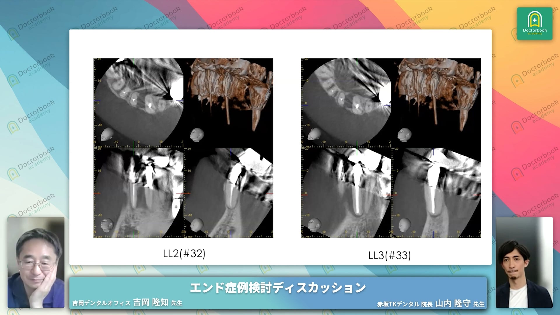 左下2番、3番の間に透過像を認める症例│山内隆守先生 CASE3