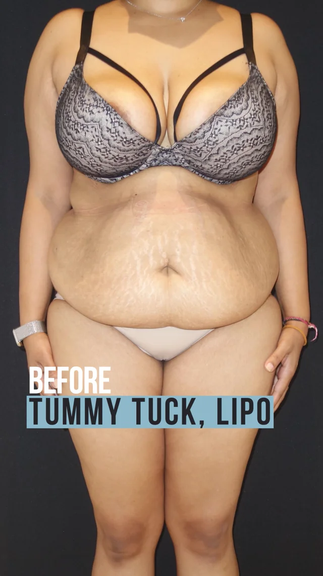 Liposuction Body Contouring - Toronto Cosmetic Surgery