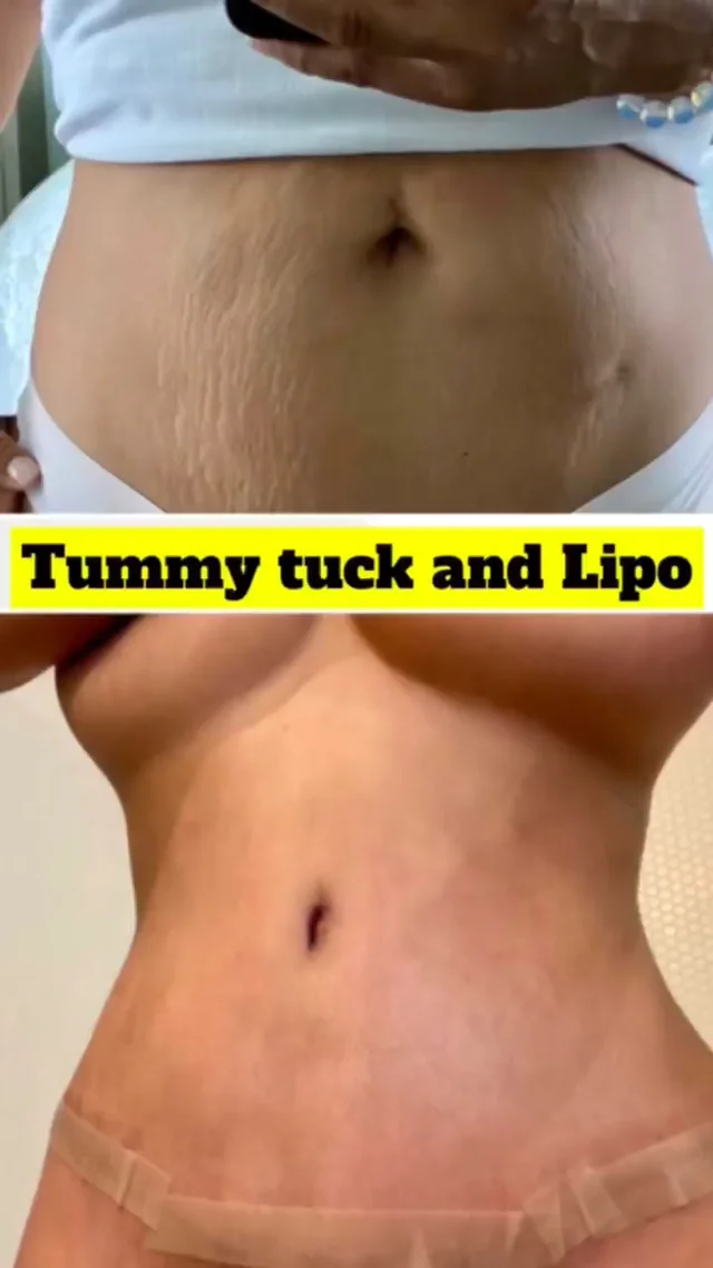 Tummy Tuck in Los Altos  What is Abdominoplasty?