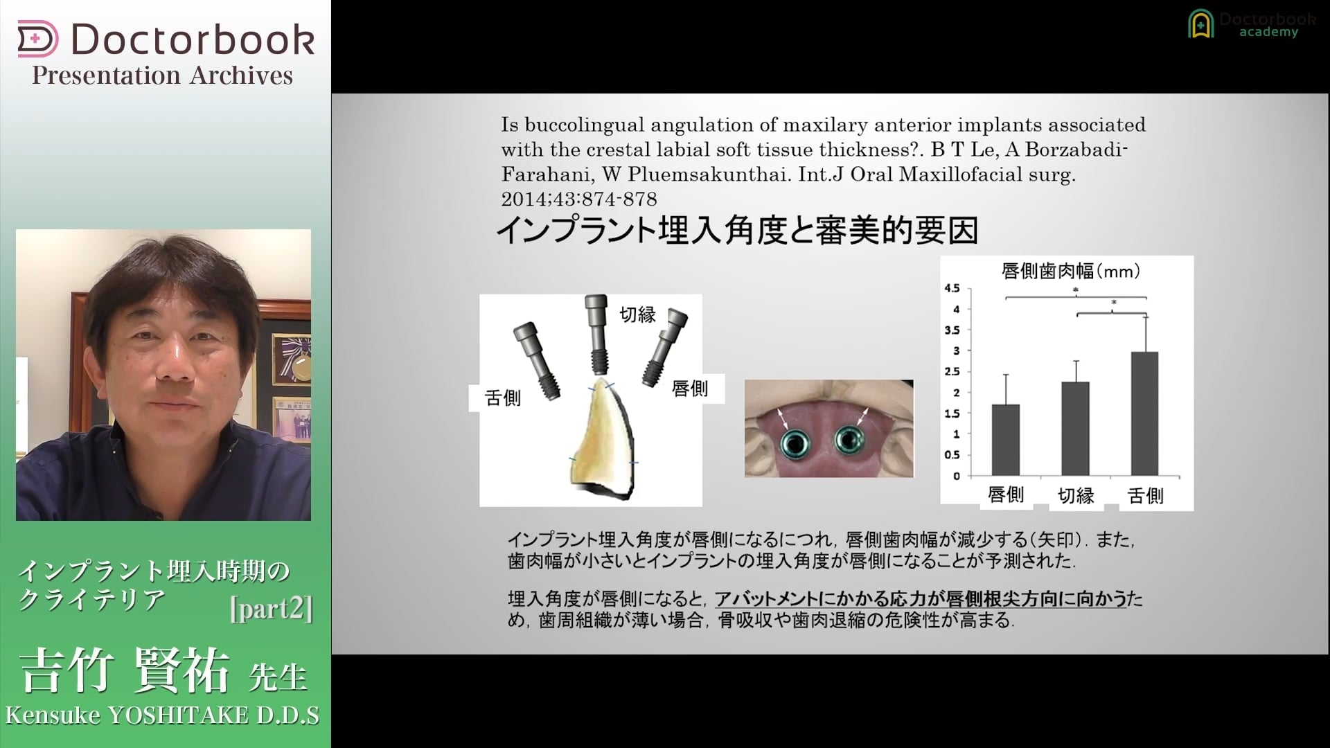 臨床知見録_初めてのインプラント一本埋入_インプラント埋入角度と審美的要因