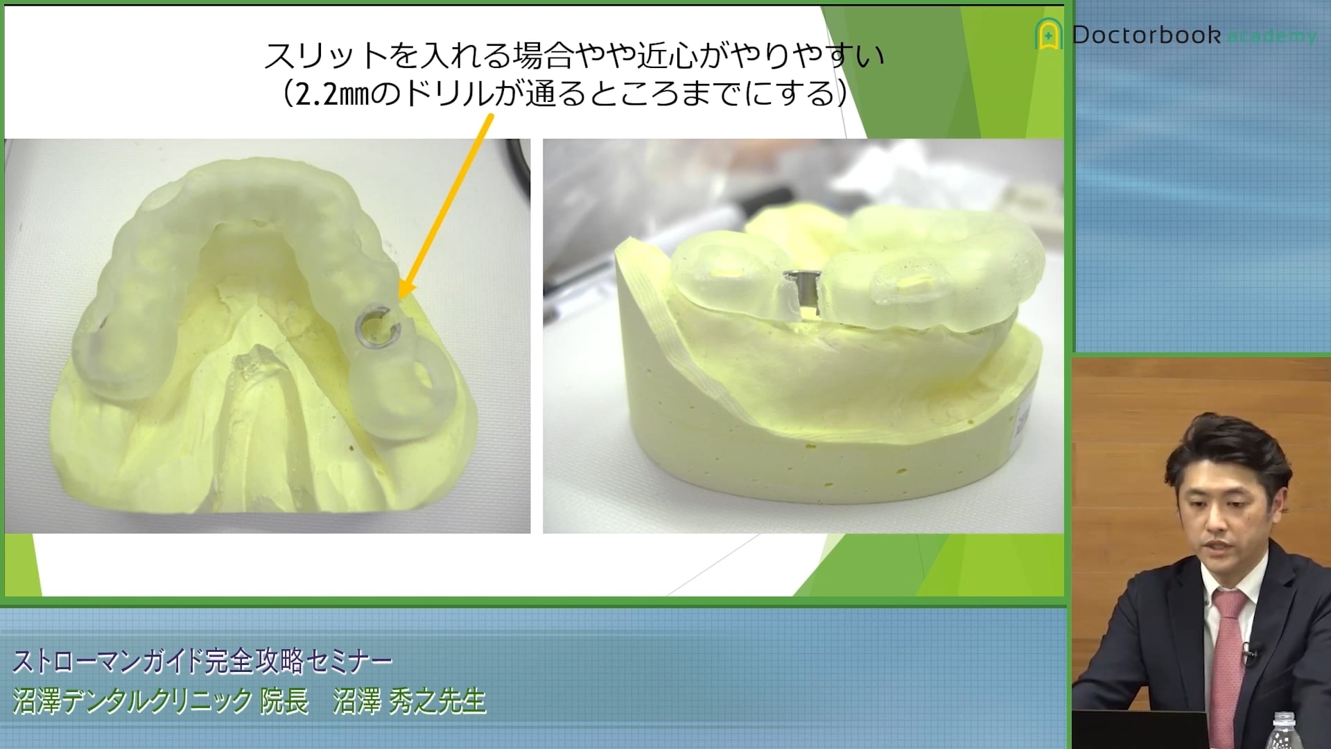 臨床知見録_初めてのインプラント一本埋入_開咬距離が少ない場合についての解決方法