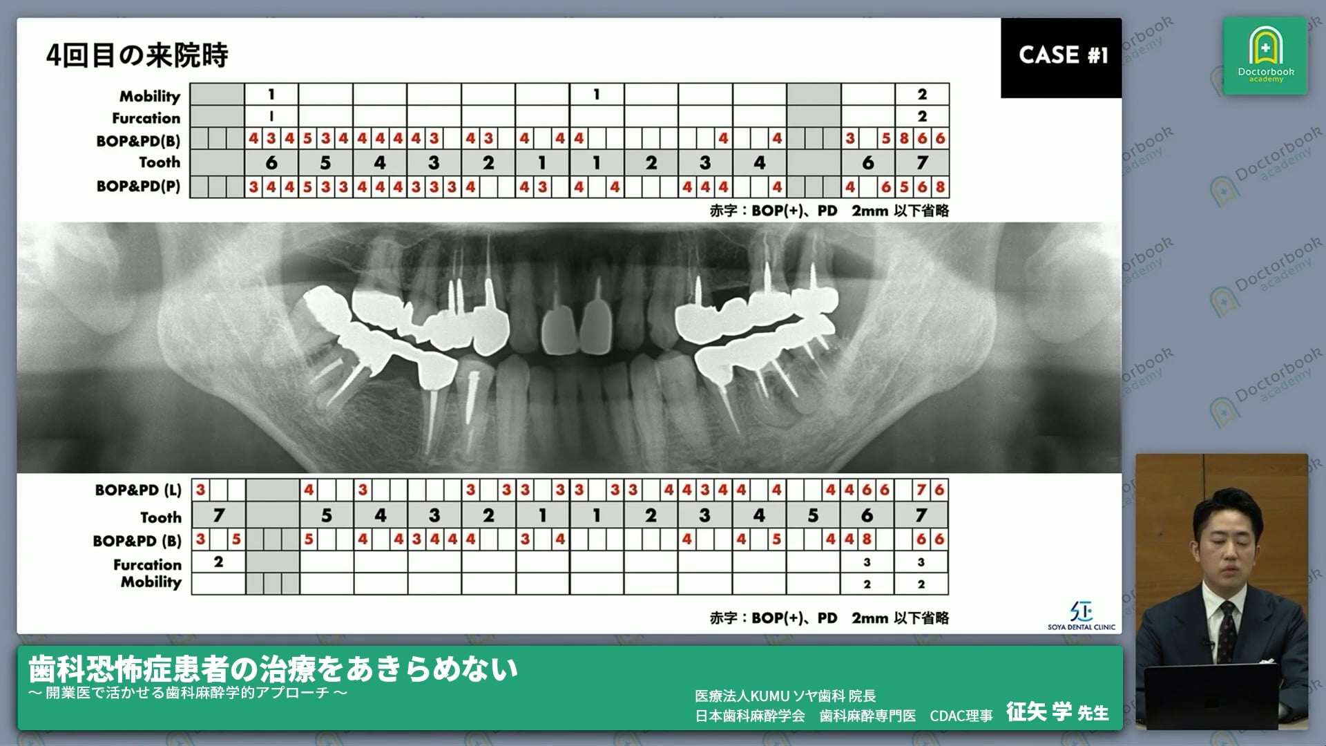 歯科恐怖症患者への対応方法1：吸入鎮静法 #2