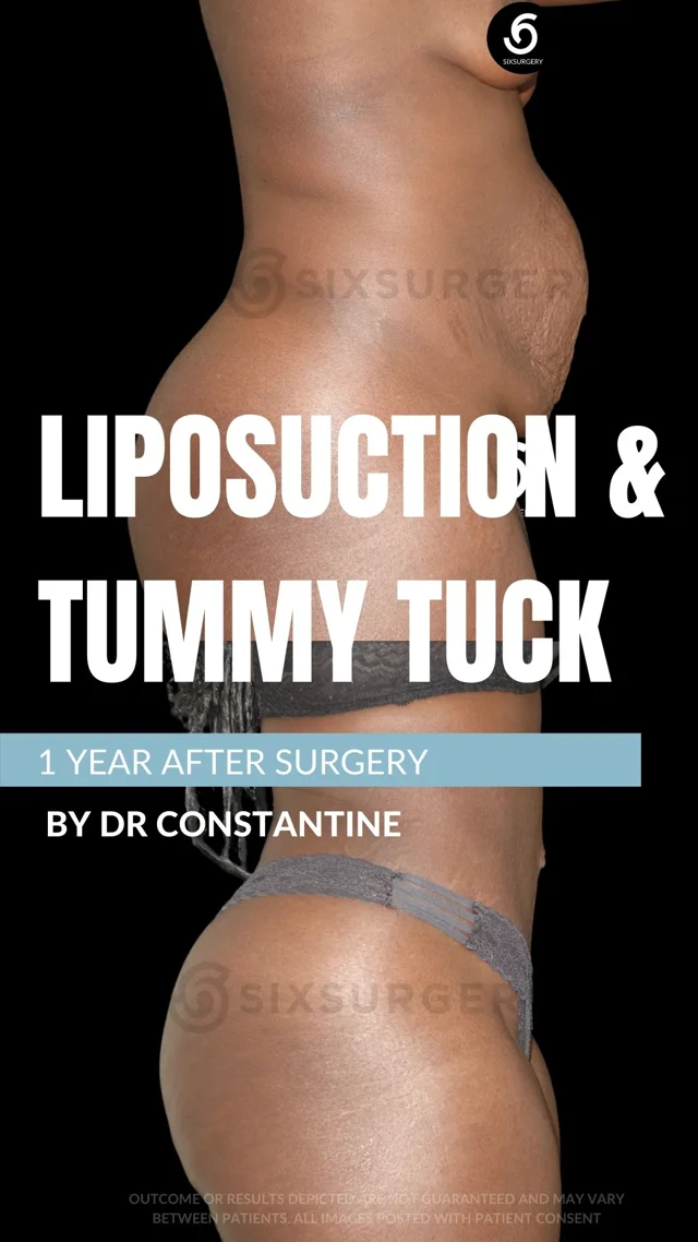 Liposuction in Toronto  Canadian Plastic Surgery Centre Toronto