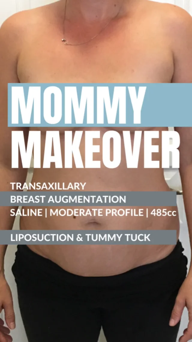 Mommy Makeover Miami - Mommy Makeovers in Miami (Tummy Tuck, Breast Lift &  Liposuction)