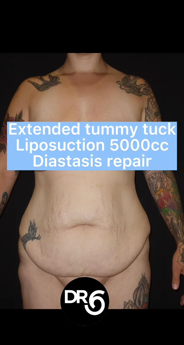 Body Contouring Sculpting Surgery - Toronto Surgery