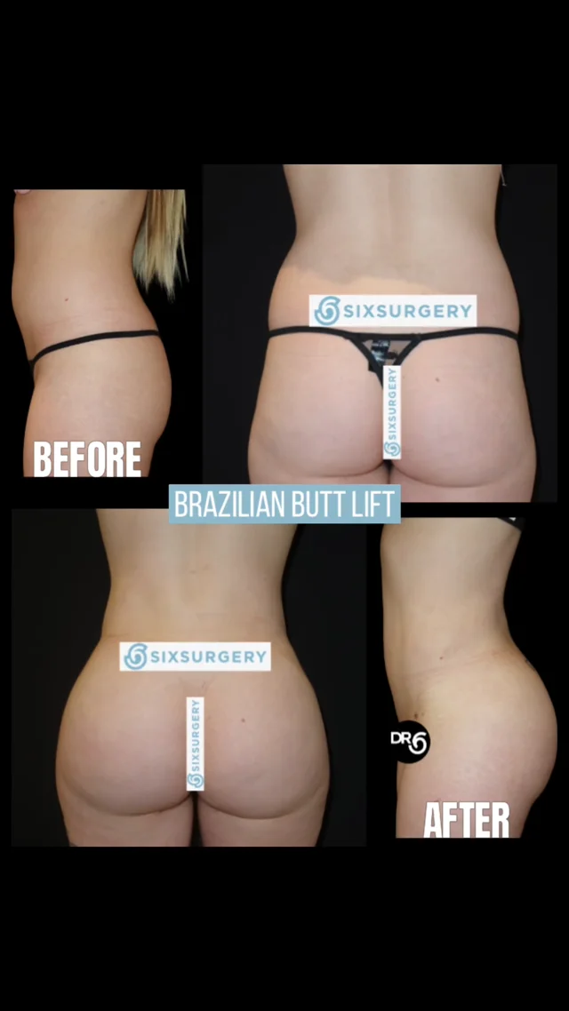 The Ultimate Guide to Buttock Lift Surgery with Dr. Barr