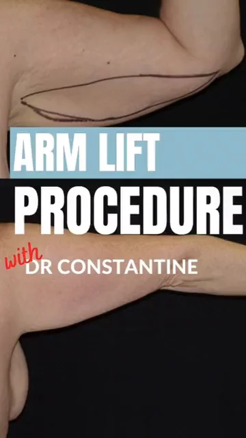 Brachioplasty Arm Lift Surgery Toronto Surgery