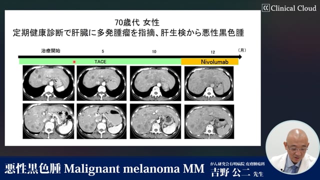 悪性黒色腫 Malignant melanoma MM