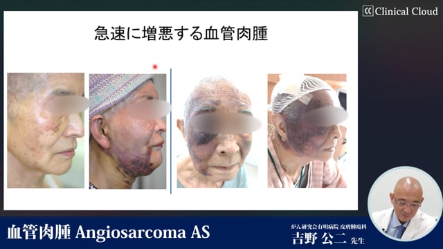 血管肉腫 Angiosarcoma AS