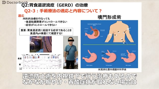 GERDは重症化すると癌になる？日々の生活習慣を見直していくことが大切