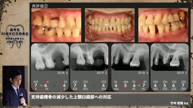 【ペリオ班】支持歯槽骨の減少した上顎臼歯部への対応│竹中 宏隆先生