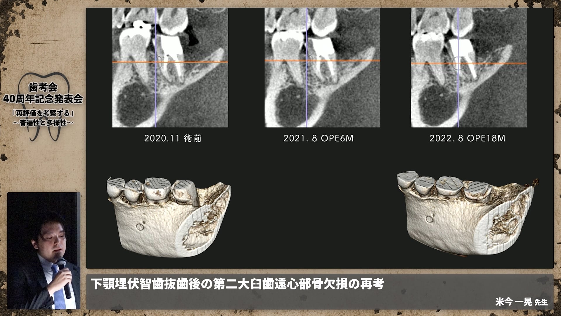 【ペリオ班】下顎埋伏智歯抜歯後の第二大臼歯遠心部の骨欠損の再考│米今 一晃先生