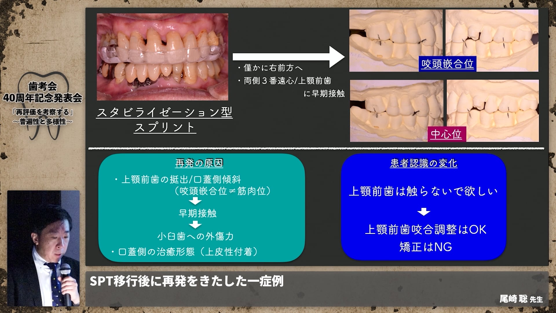 【ペリオ班】SPT移行後に再発をきたした１症例│尾崎 聡先生