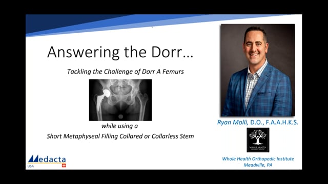 Tackling the Challenge of Dorr Type A Femurs