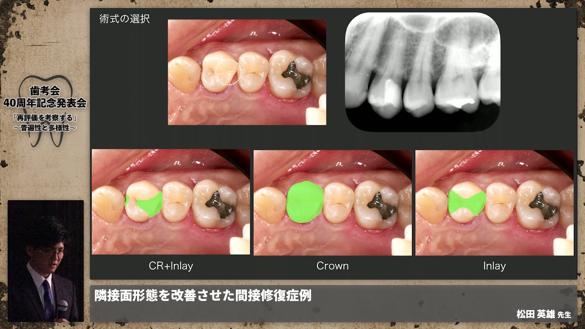 【補綴班】隣接面形態を改善させた間接修復症例│松田 英雄先生