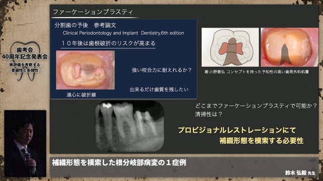 【補綴班】補綴形態を模索した根分岐部病変の１症例│鈴木 弘毅先生