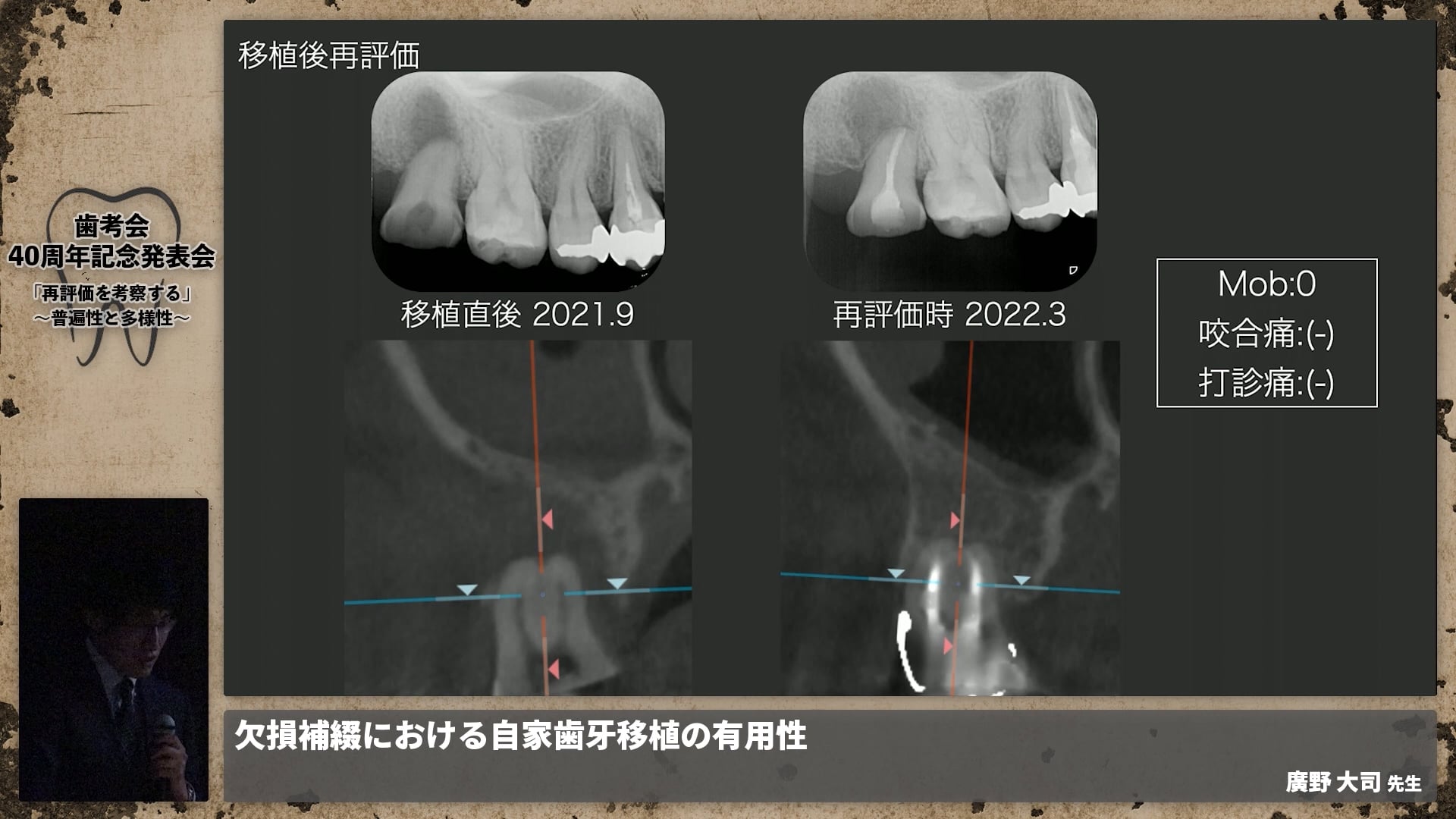 【補綴班】欠損補綴における自家歯牙移植の有用性│廣野 大司先生