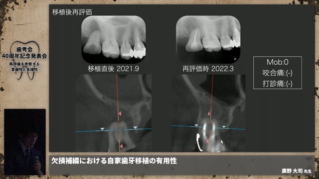 【補綴班】欠損補綴における自家歯牙移植の有用性│廣野 大司先生