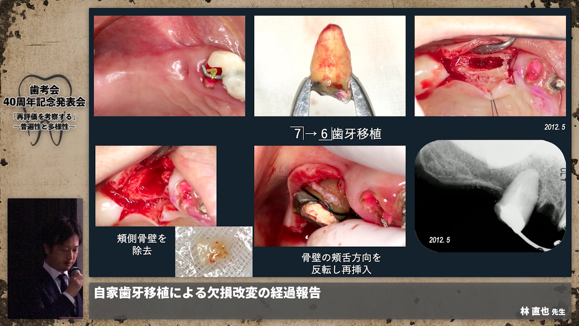 【補綴班】自家歯牙移植による欠損改変の経過報告│林 直也先生