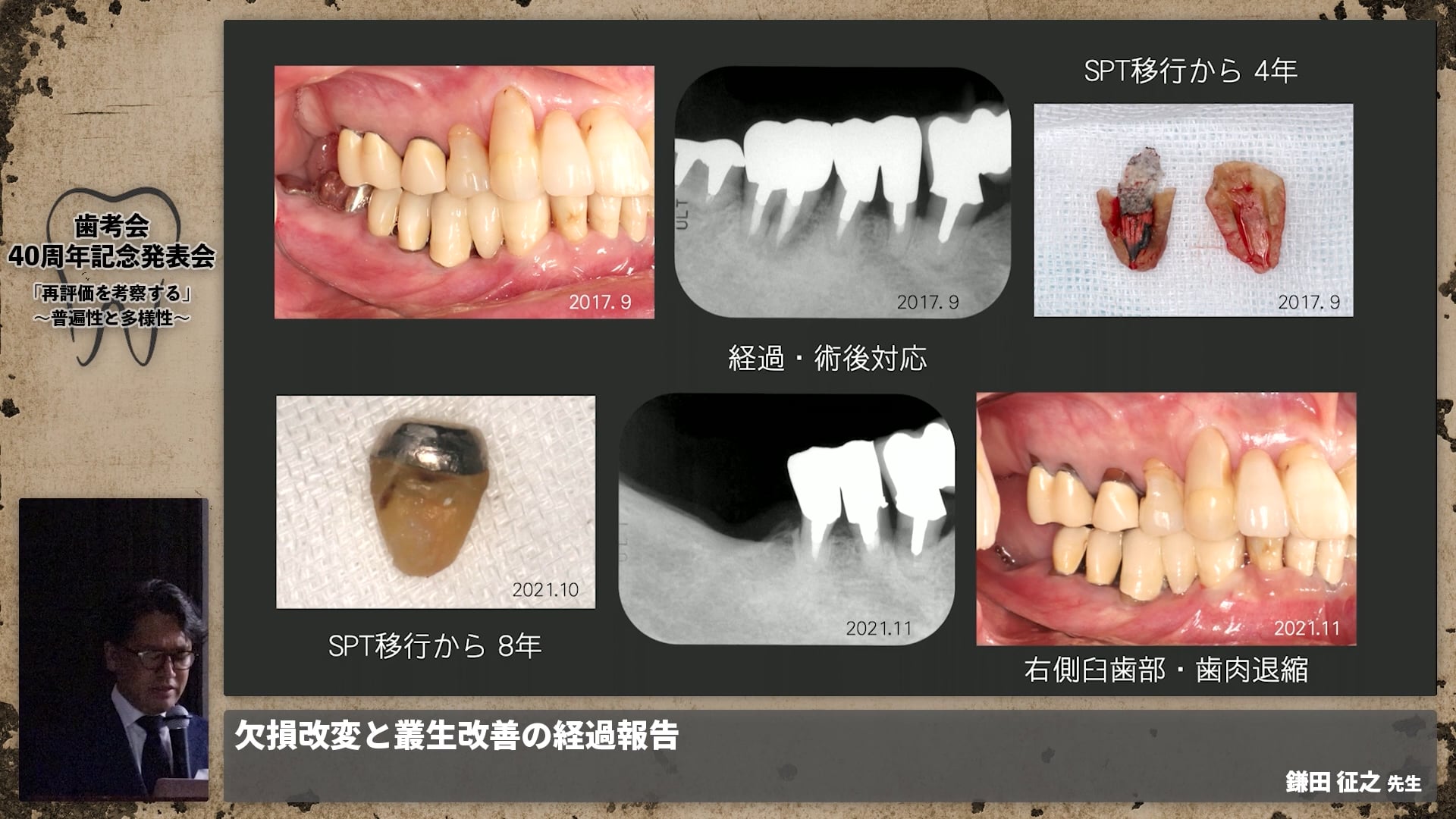 【補綴班】欠損改変と叢生改善の経過報告│鎌田 征之先生