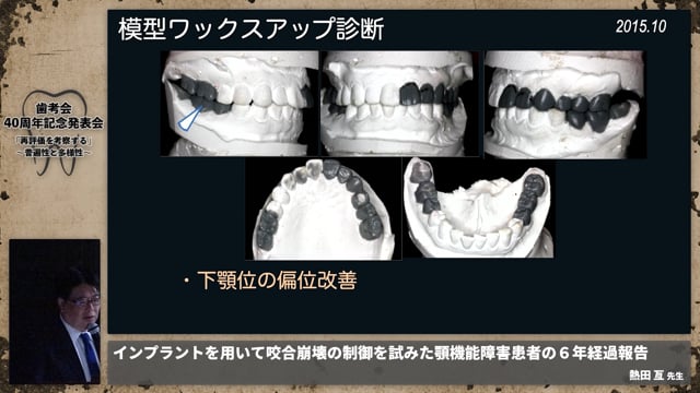 【顎機能障害班】インプラントを用いて咬合崩壊の制御を試みた顎機能障害患者の6年経過報告│熱田 亙先生