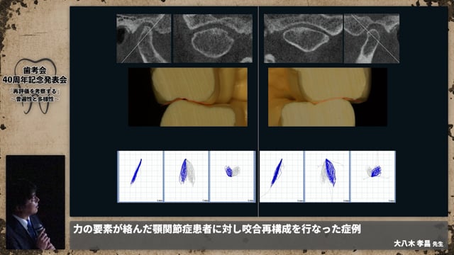 【顎機能障害班】力の要素が絡んだ顎関節症患者に対し咬合再構成を行なった症例 │大八木 孝昌先生